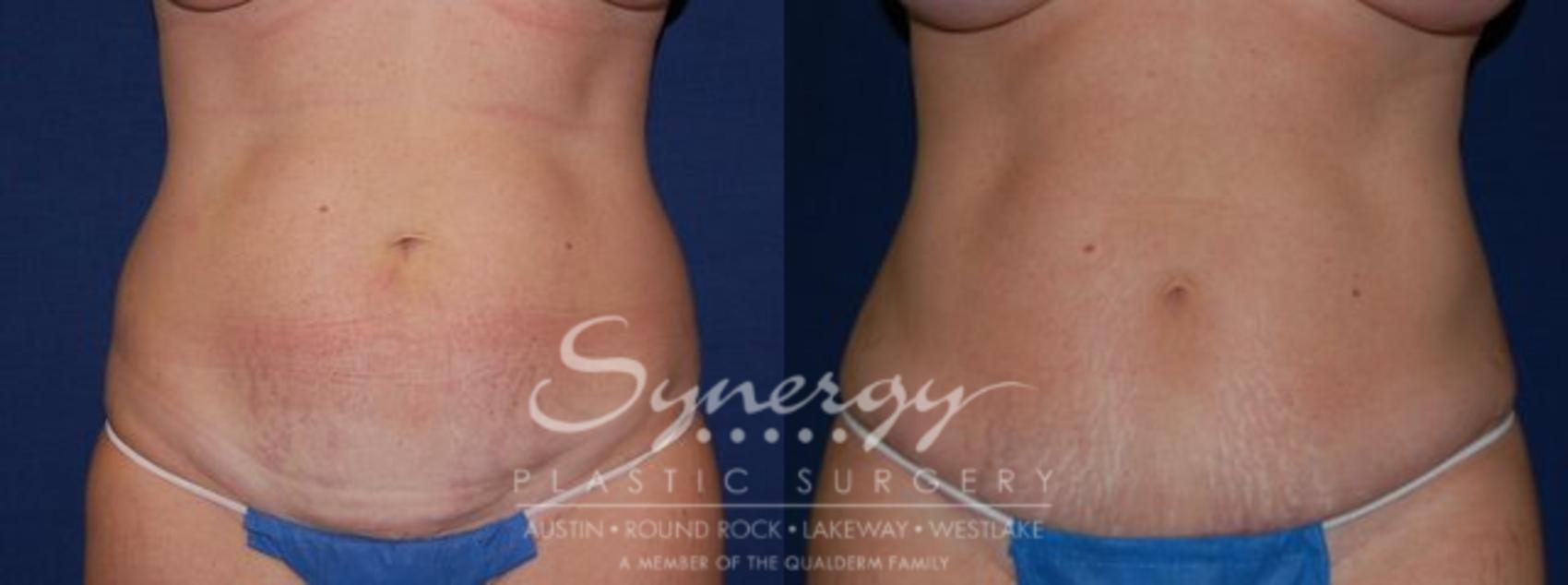 Before & After Abdominoplasty (Tummy Tuck) Case 55 View #1 View in Austin, TX