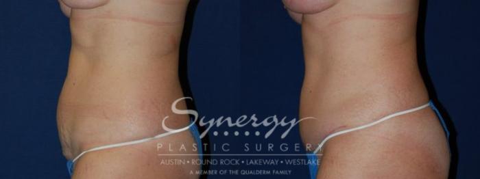 Before & After Abdominoplasty (Tummy Tuck) Case 55 View #2 View in Austin, TX