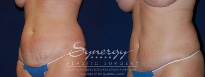 Before & After Abdominoplasty (Tummy Tuck) Case 55 View #3 View in Austin, TX