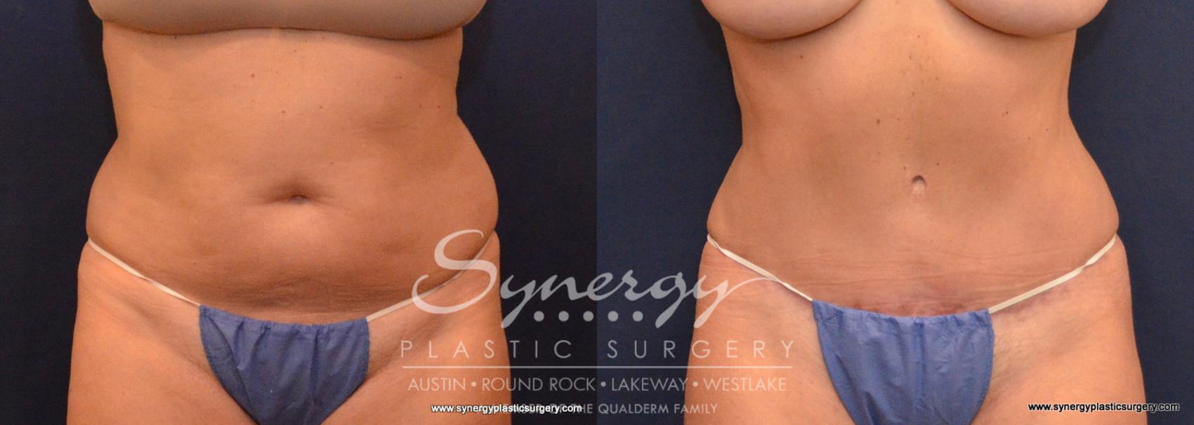 Before & After  Case 576 View #1 View in Austin, TX