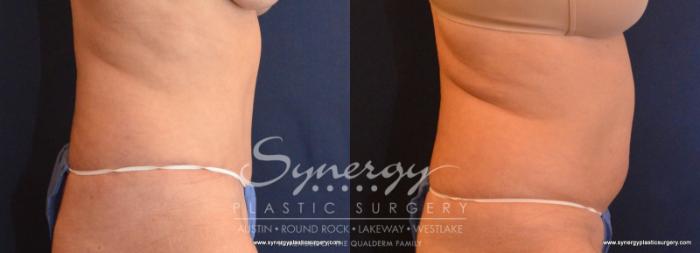 Before & After  Case 576 View #2 View in Austin, TX