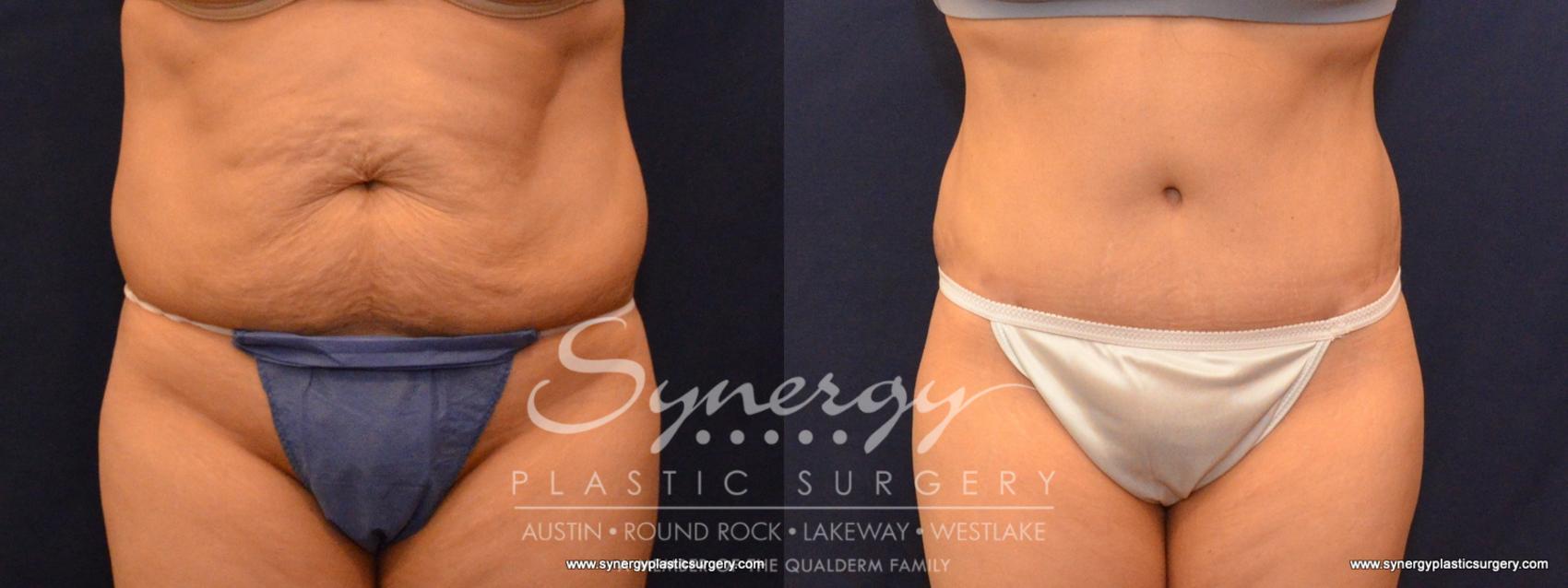 Before & After Abdominoplasty (Tummy Tuck) Case 583 View #1 View in Austin, TX