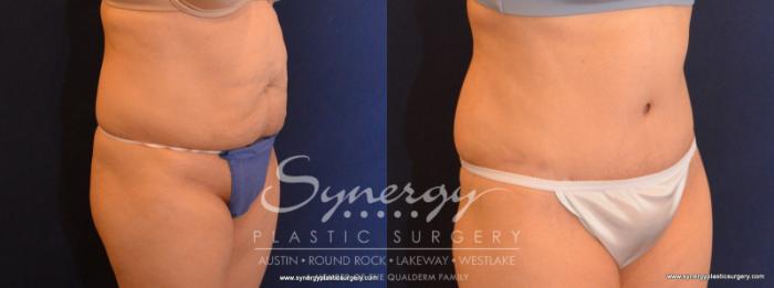 Before & After Abdominoplasty (Tummy Tuck) Case 583 View #4 View in Austin, TX