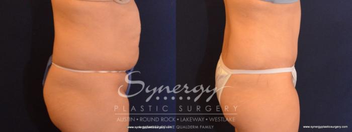 Before & After Abdominoplasty (Tummy Tuck) Case 583 View #5 View in Austin, TX