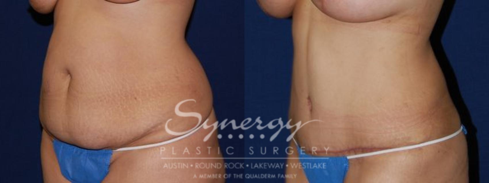 Before & After Abdominoplasty (Tummy Tuck) Case 59 View #1 View in Austin, TX