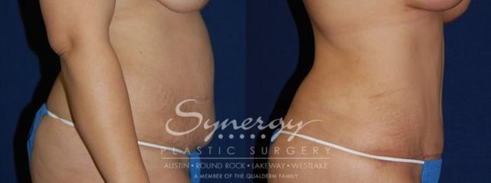 Before & After Abdominoplasty (Tummy Tuck) Case 59 View #3 View in Austin, TX