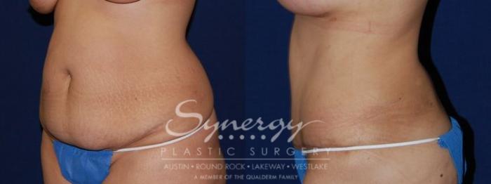 Before & After Abdominoplasty (Tummy Tuck) Case 59 View #4 View in Austin, TX