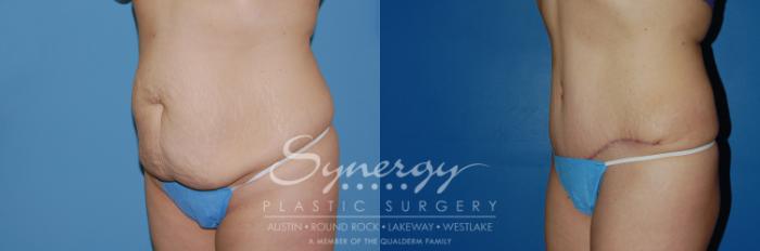 Before & After Abdominoplasty (Tummy Tuck) Case 6 View #2 View in Austin, TX