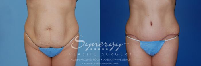 Before & After Abdominoplasty (Tummy Tuck) Case 6 View #3 View in Austin, TX