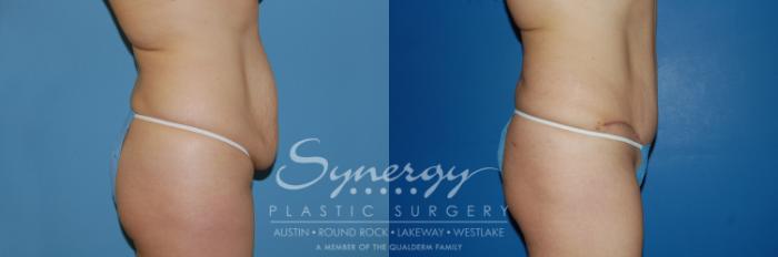 Before & After Abdominoplasty (Tummy Tuck) Case 6 View #5 View in Austin, TX