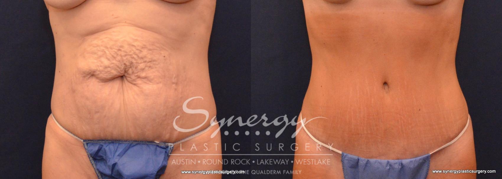 Before & After Abdominoplasty (Tummy Tuck) Case 607 View #1 View in Austin, TX