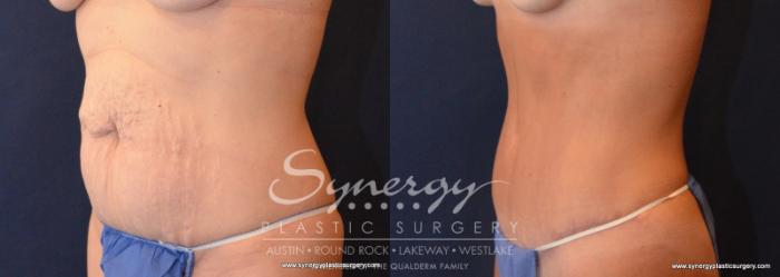 Before & After Abdominoplasty (Tummy Tuck) Case 607 View #2 View in Austin, TX