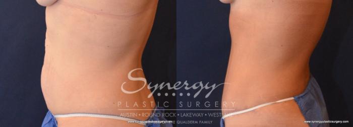 Before & After Abdominoplasty (Tummy Tuck) Case 607 View #3 View in Austin, TX