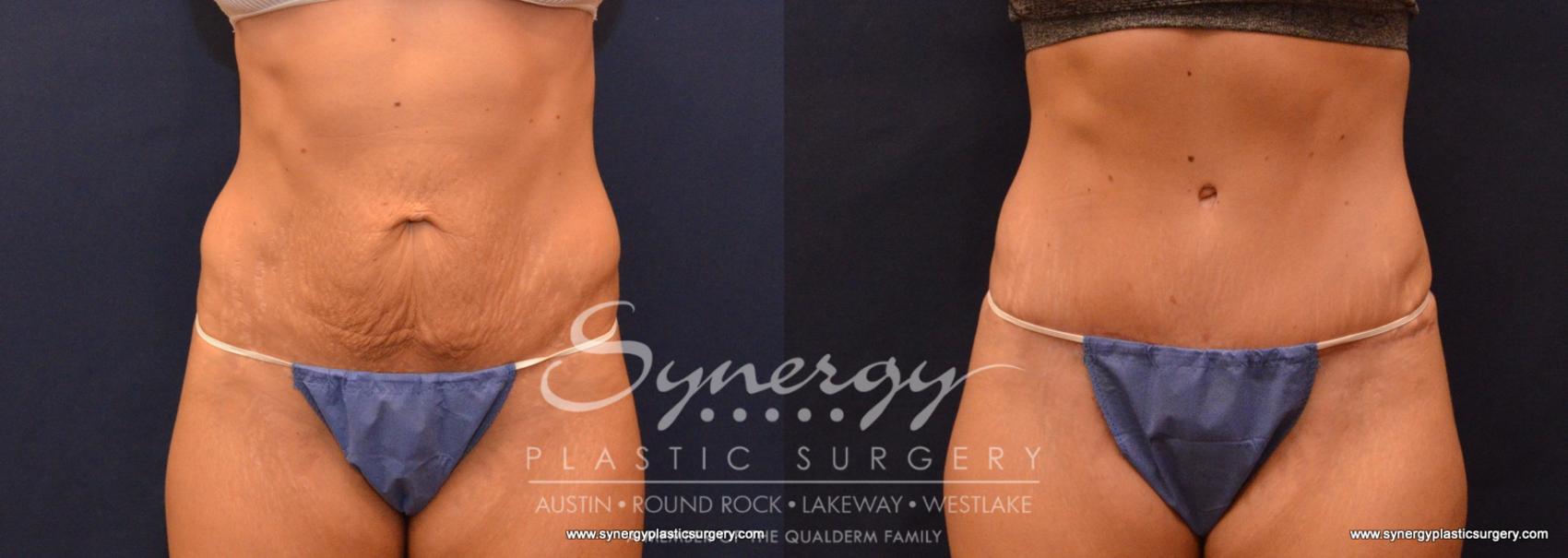 Before & After  Case 617 View #1 View in Austin, TX