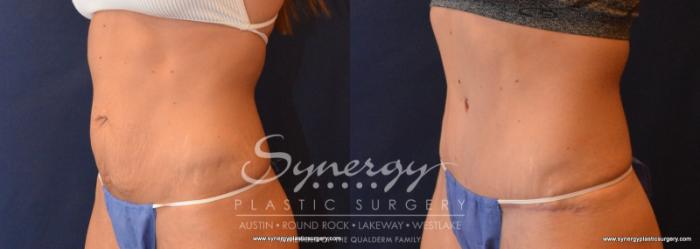 Before & After  Case 617 View #3 View in Austin, TX