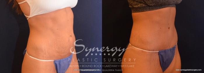 Before & After  Case 617 View #4 View in Austin, TX