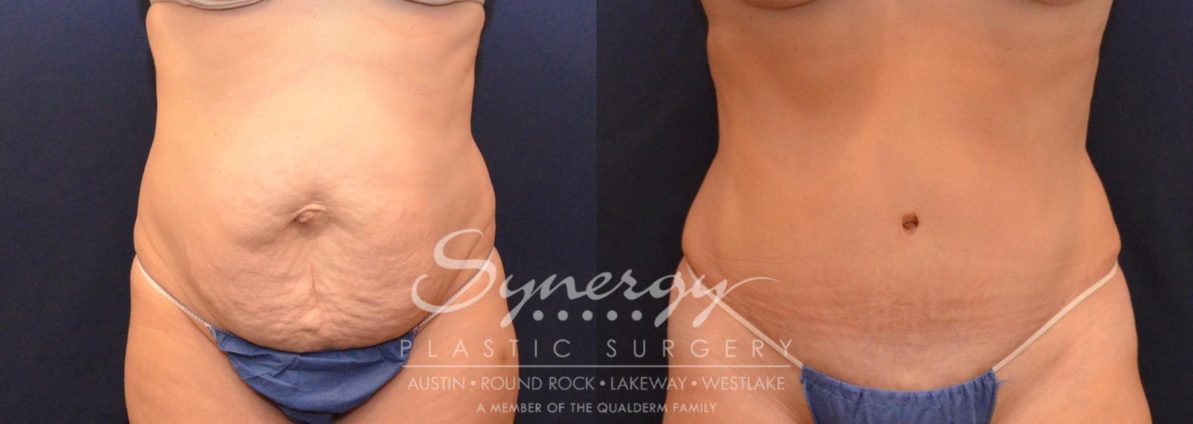Before & After Abdominoplasty (Tummy Tuck) Case 630 View #1 View in Austin, TX