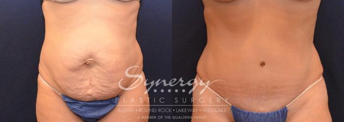 Before & After Abdominoplasty (Tummy Tuck) Case 630 View #1 View in Austin, TX