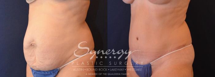 Before & After Abdominoplasty (Tummy Tuck) Case 630 View #2 View in Austin, TX