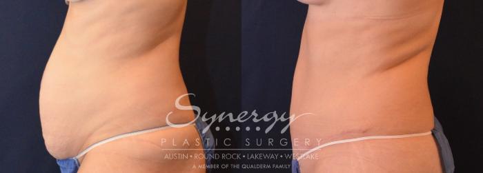 Before & After Abdominoplasty (Tummy Tuck) Case 630 View #3 View in Austin, TX