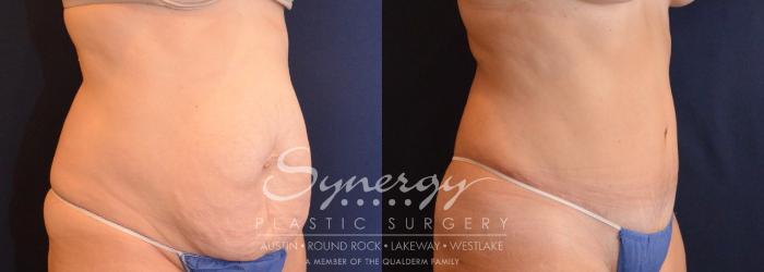 Before & After Abdominoplasty (Tummy Tuck) Case 630 View #4 View in Austin, TX