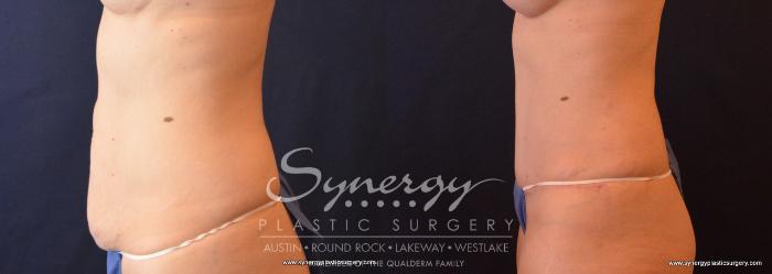 Before & After Abdominoplasty (Tummy Tuck) Case 661 View #3 View in Austin, TX