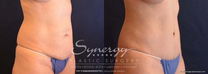 Before & After Abdominoplasty (Tummy Tuck) Case 661 View #4 View in Austin, TX
