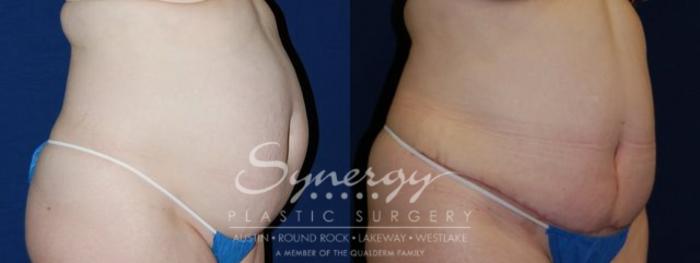 Before & After Abdominoplasty (Tummy Tuck) Case 67 View #3 View in Austin, TX