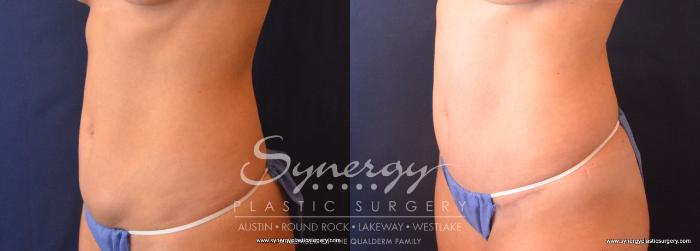 Before & After Abdominoplasty (Tummy Tuck) Case 682 View #2 View in Austin, TX