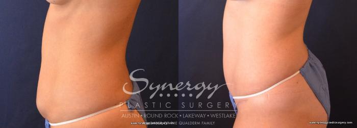 Before & After Abdominoplasty (Tummy Tuck) Case 682 View #3 View in Austin, TX
