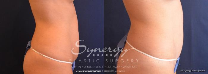 Before & After Abdominoplasty (Tummy Tuck) Case 682 View #4 View in Austin, TX
