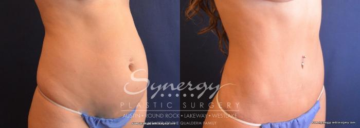 Before & After Abdominoplasty (Tummy Tuck) Case 698 View #2 View in Austin, TX