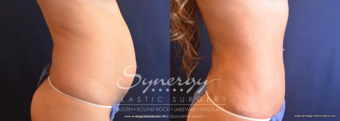 Before & After Abdominoplasty (Tummy Tuck) Case 698 View #3 View in Austin, TX