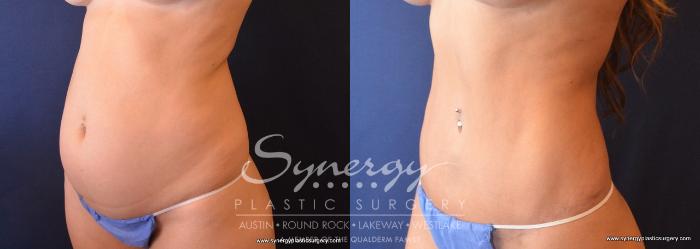 Before & After Abdominoplasty (Tummy Tuck) Case 698 View #5 View in Austin, TX