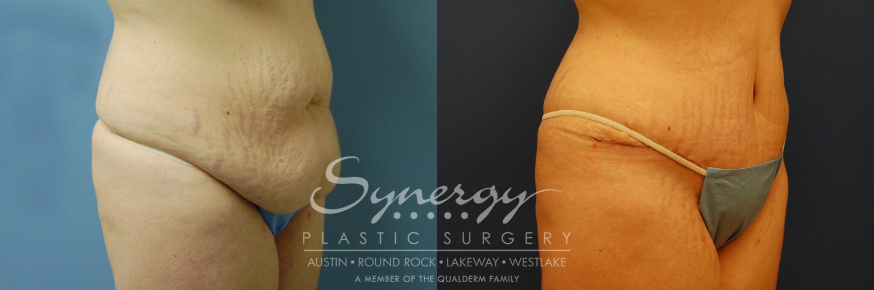 Before & After Abdominoplasty (Tummy Tuck) Case 7 View #1 View in Austin, TX