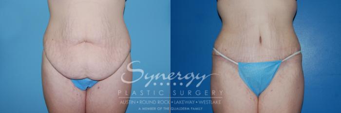 Before & After Abdominoplasty (Tummy Tuck) Case 7 View #2 View in Austin, TX