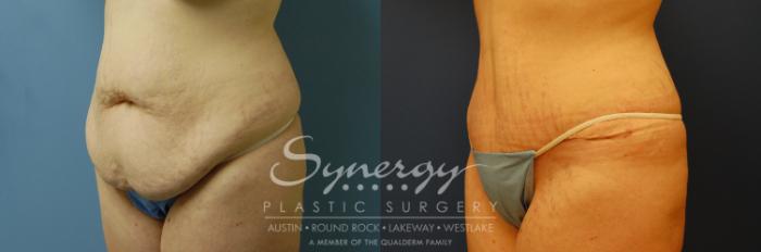 Before & After Abdominoplasty (Tummy Tuck) Case 7 View #3 View in Austin, TX