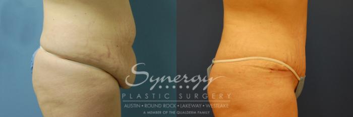 Before & After Abdominoplasty (Tummy Tuck) Case 7 View #4 View in Austin, TX