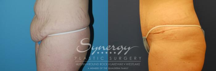 Before & After Abdominoplasty (Tummy Tuck) Case 7 View #5 View in Austin, TX
