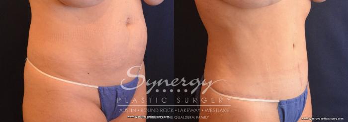 Before & After Abdominoplasty (Tummy Tuck) Case 702 View #3 View in Austin, TX