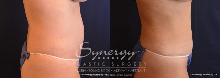 Before & After Abdominoplasty (Tummy Tuck) Case 702 View #4 View in Austin, TX