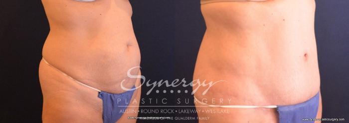 Before & After Abdominoplasty (Tummy Tuck) Case 706 View #2 View in Austin, TX