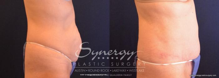 Before & After Abdominoplasty (Tummy Tuck) Case 706 View #3 View in Austin, TX