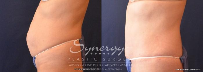 Before & After Abdominoplasty (Tummy Tuck) Case 706 View #4 View in Austin, TX