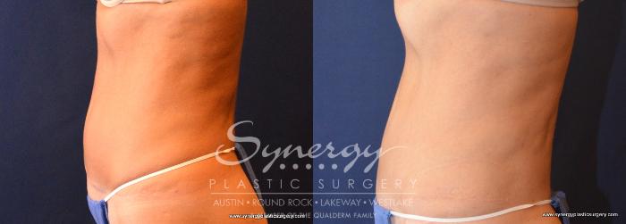 Before & After Abdominoplasty (Tummy Tuck) Case 707 View #3 View in Austin, TX