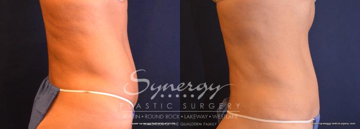 Before & After Abdominoplasty (Tummy Tuck) Case 707 View #4 View in Austin, TX