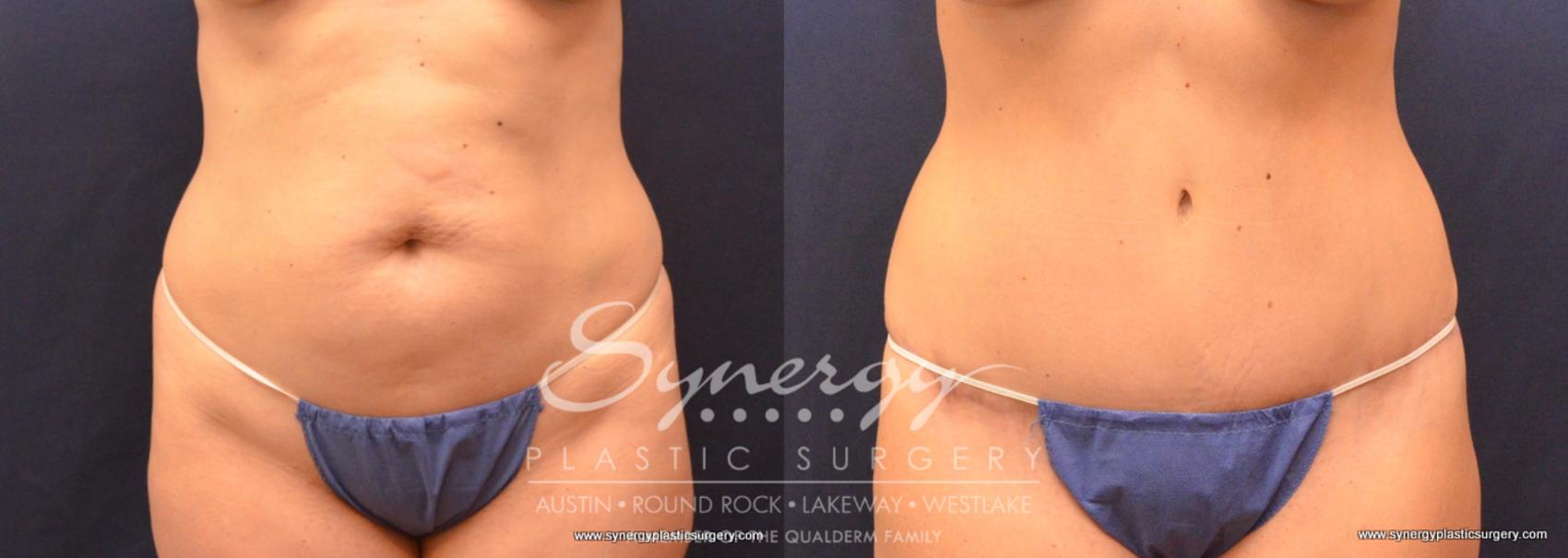 Before & After Abdominoplasty (Tummy Tuck) Case 721 View #1 View in Austin, TX