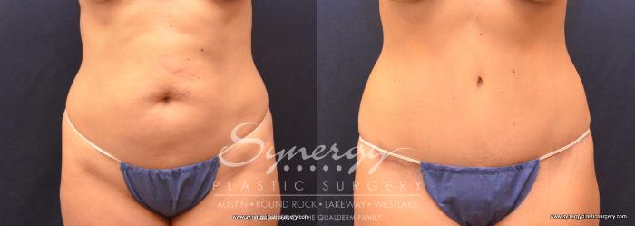 Before & After Abdominoplasty (Tummy Tuck) Case 721 View #1 View in Austin, TX