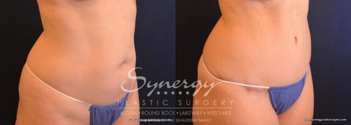Before & After Abdominoplasty (Tummy Tuck) Case 721 View #2 View in Austin, TX