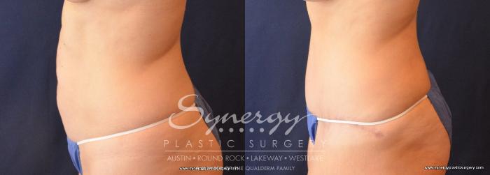 Before & After Abdominoplasty (Tummy Tuck) Case 721 View #3 View in Austin, TX